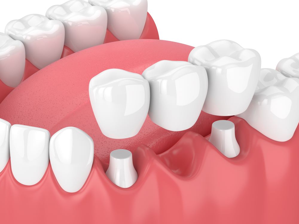 A computer-generated image of a dental bridge being attached to two teeth.